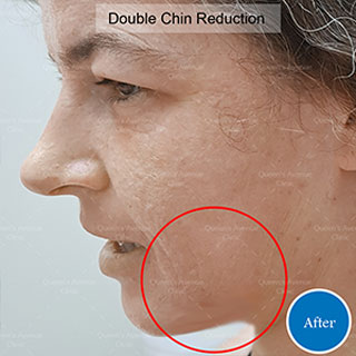 After Double Chin Reduction Treatment