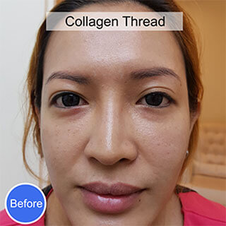 Before Collagen Thread Treatment