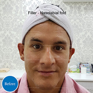 Before Filler to Nasolabial Folds Treatment