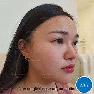 After Nose Augmentation