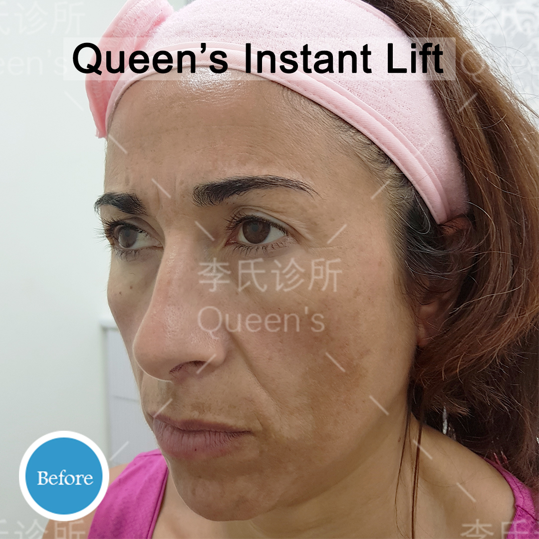 Rita-Pisu-Before-Instant-Lift-Treatment